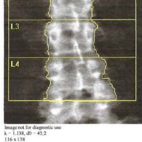 Change of Size of Lumbar Spine Region of Interest Over Time