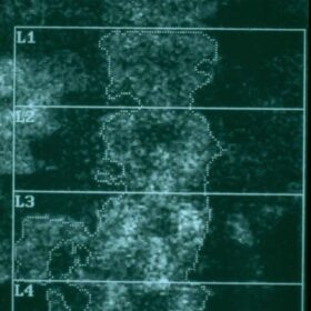 Edge Detection Problem in the Lumbar Spine