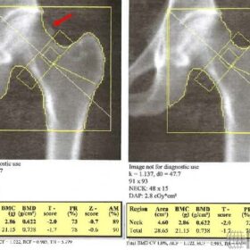 Femoral Head is Not Outlined/ Hip Edge Detection Issues