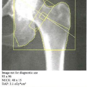 Femoral Neck Box Includes Part of the Ischium