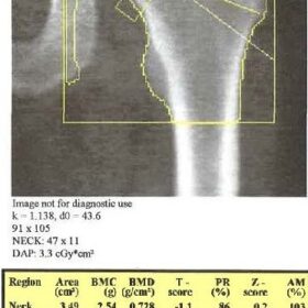 Incorrect Femoral Neck Box Width/Hologic