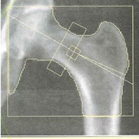 Femoral Neck Region of Interest Positioning/ Hologic