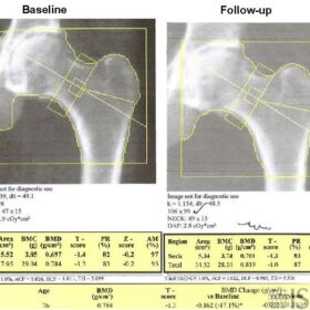Follow-up Differences in Hip Global Region of Interest