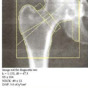 Incorrect Hologic Femoral Neck Box Width