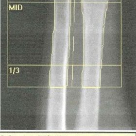 Incorrect Hologic Forearm Analysis