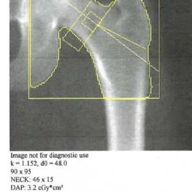 Incorrect Hologic Femoral Neck Box Length/ Hologic