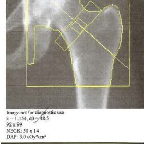 Femoral Neck Box Size Incorrect