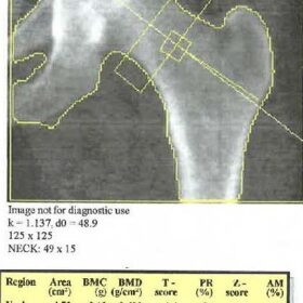 Incorrect Hologic Hip Analysis
