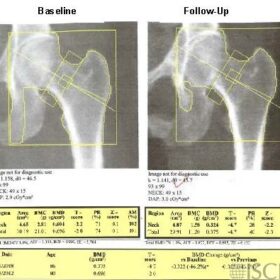 Follow-up Hip Scan with the Lesser Trochanter Incompletely Outlined