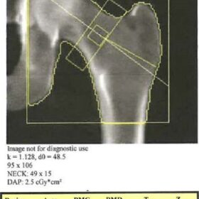 Long Femur Scan