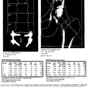 Incorrect Spine and Hip Analysis