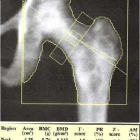 Mastocytosis