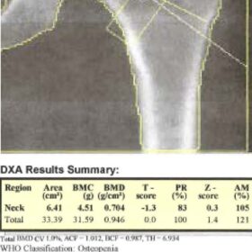 Incorrect Hologic Hip Analysis