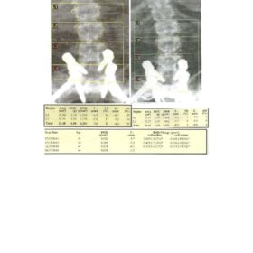 Effects of Spinal Hardware on Spine DXA Analysis