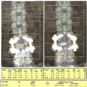 Effects of Spinal Hardware on Spine DXA Analysis
