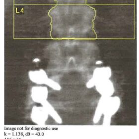 Spinal Level Identification