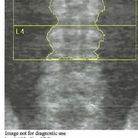 Spinal Level Identification