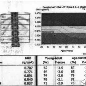 Spinal Level Identifiation