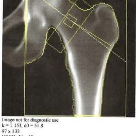 Hologic Total Hip Region of Interest Box Incorrect
