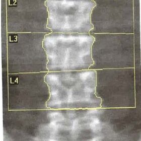 Turner's Syndome