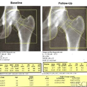 Wrong Hologic Total Hip Global Region of Interest Size on Follow-up