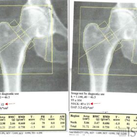 Incorrect Femoral Neck Box Size