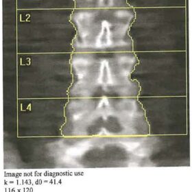 5 Lumbar Vertebral Bodies with Lowest Ribs on T11 vs. 6 Lumbar Vertebral Bodies