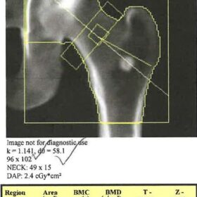 Calcifications in the Soft Tissue Projecting over the Left Hip