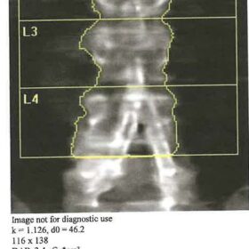 Common Iliac Stents