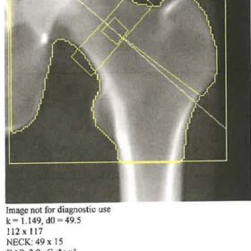 Femoral Neck Box Incorrectly Positioned/ Hologic