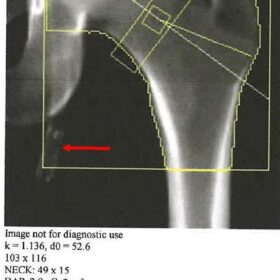 Left Femoral Stent/Graft