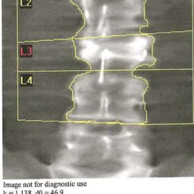 Burst Fracture of L3