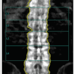 Normal GE Spine Analysis