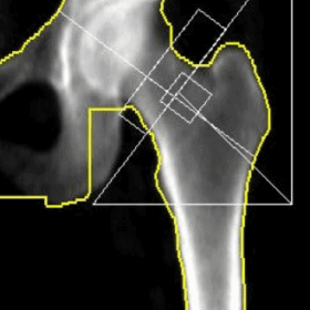 GE Normal Hip