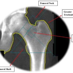Normal Left Proximal Femur Scan from a GE iDXA Densitometer
