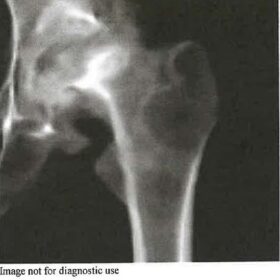 Chronic Malunited Left Subcapital Femoral Fracture