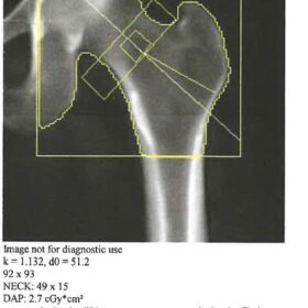 Wrong Ethnicity in Analysis of a DXA Scan