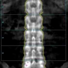 Rare GE-Lunar 4% fat, soft tissue detection failure resulting in the false appearance of extraordinarily low BMD