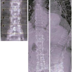 Black Hole Artifacts - Surgical Clips