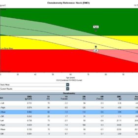 Discordant Left-Right Hip Change in Osteoarthritis