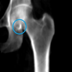 GE-Lunar Short Femoral Neck ROI Placement Challenges
