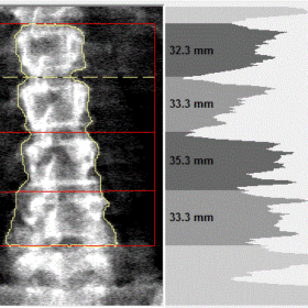 Lumbosacral Transitional Vertebra,  A case of four and one half lumbar vertebrae