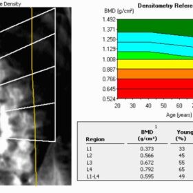 Edge Detection, Scoliosis
