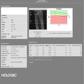 Bone Densitometry study in patient with metastatic hormone sensitive prostate cancer