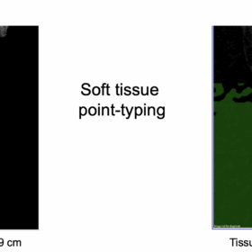 DXA Interpreters Can Suspect Forearm “Slot Error” by Evaluating Tissue Thickness Measurement