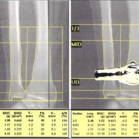 Hologic Right Forearm Scan with a Watch Artifact